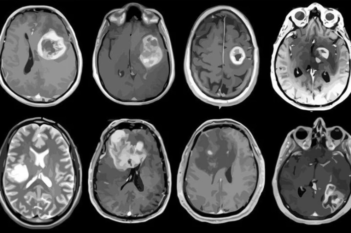 Tumor cerebral: qué es y cómo se trata la enfermedad que padeció Gerardo Rozin