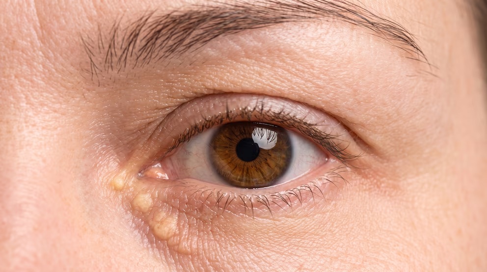 Una señal alrededor de los ojos podría anticipar un mayor riesgo cardiovascular durante años